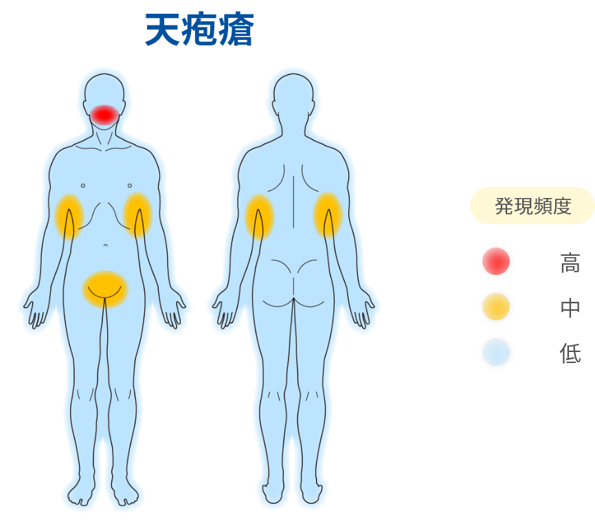天疱瘡
