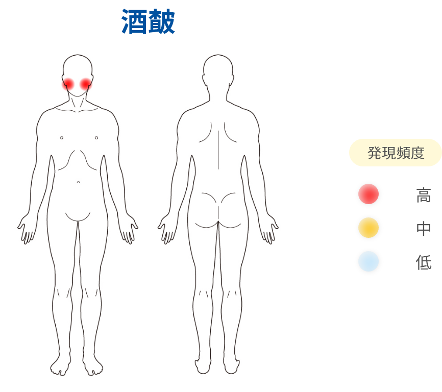 酒皶