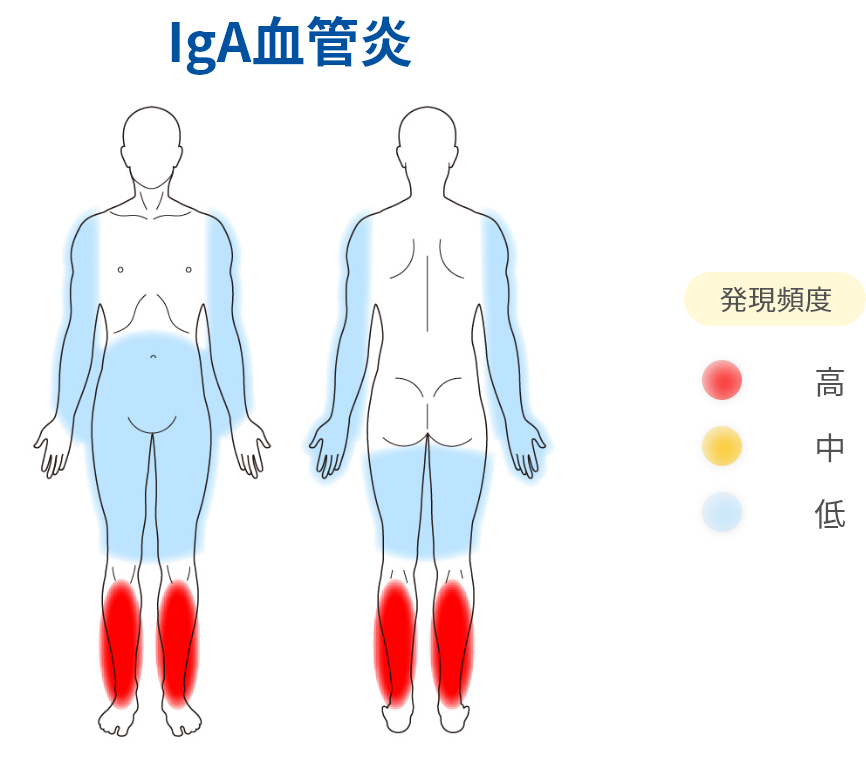 IgA血管炎