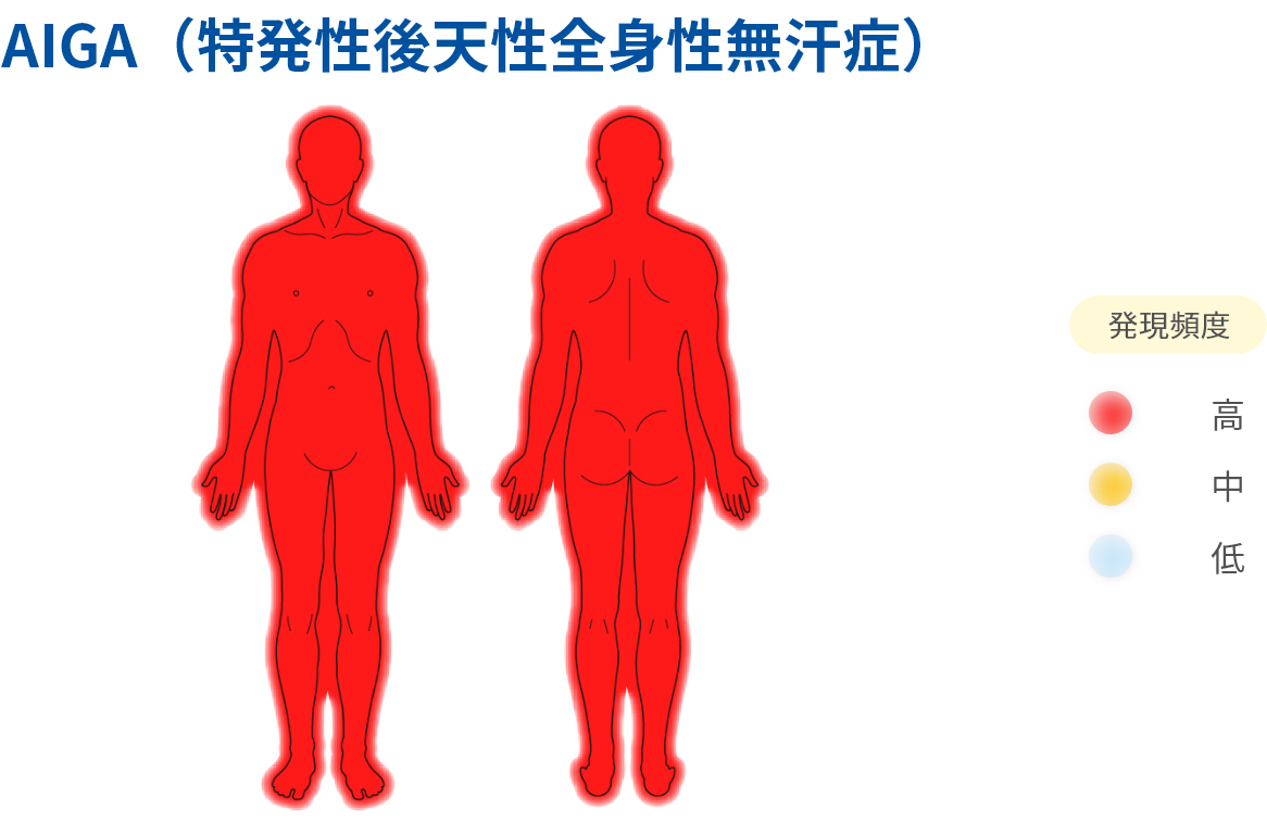 AIGA(特発性後天性全身性無汗症）