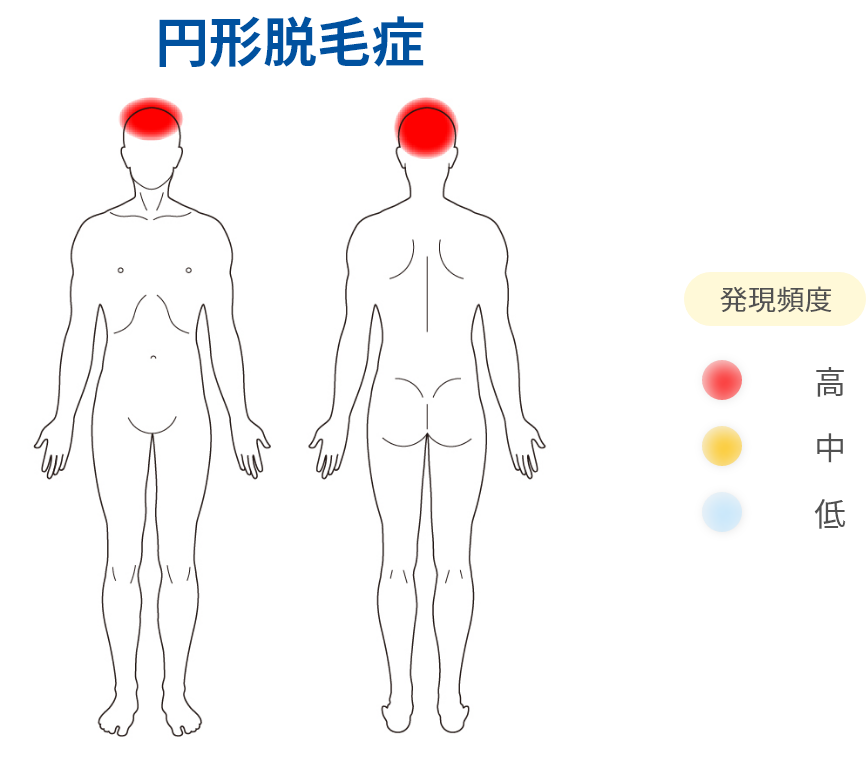 円形脱毛症