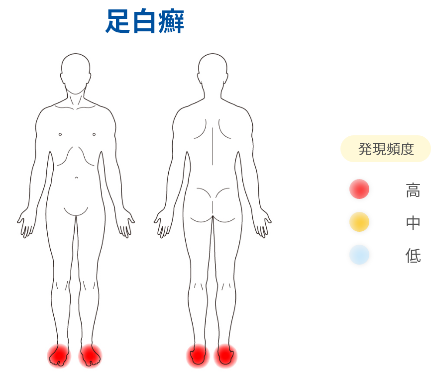 足白癬