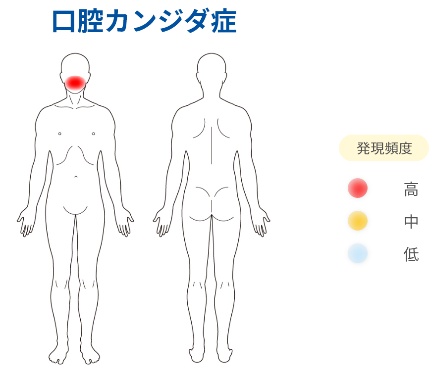 口腔カンジダ症