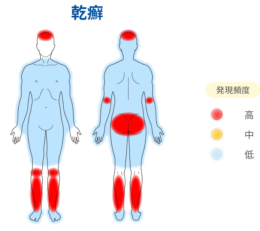 乾癬