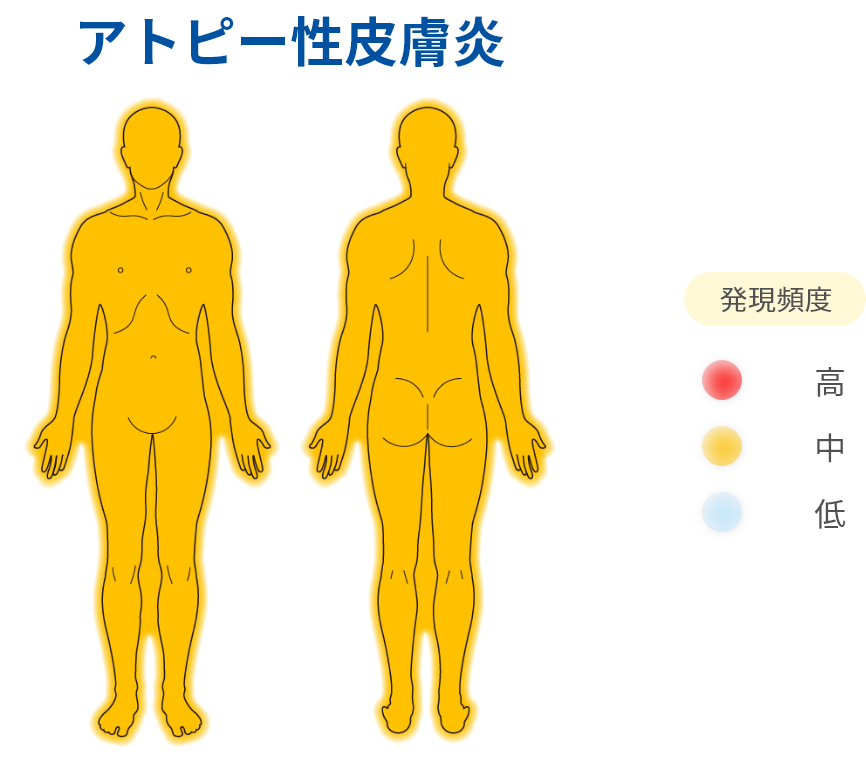 アトピー性皮膚炎