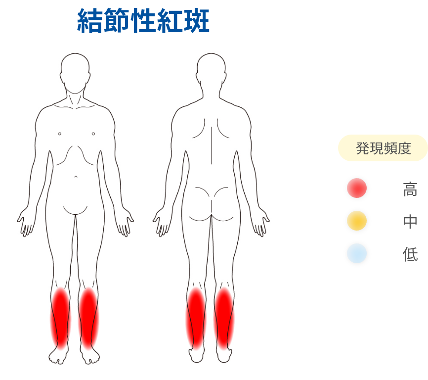 結節性紅斑