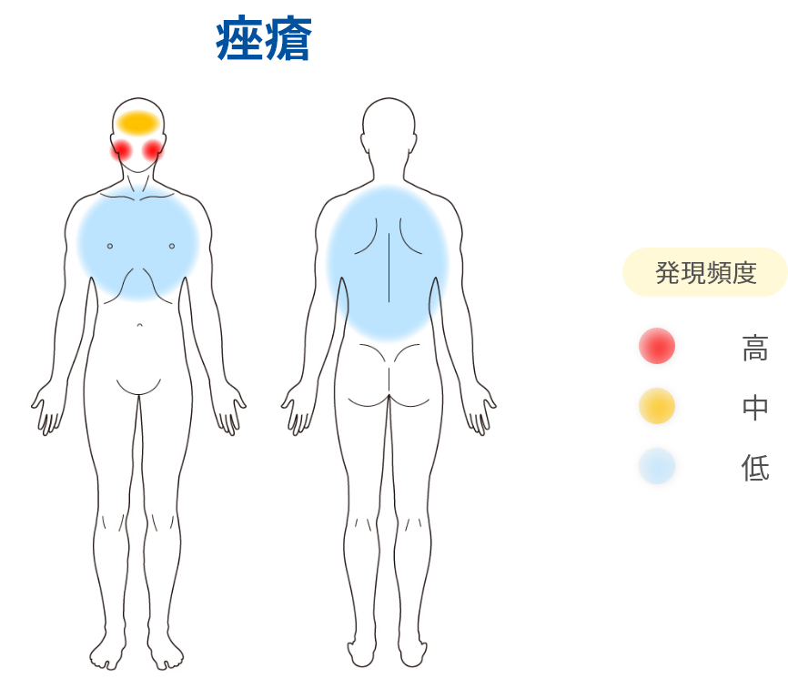 痤瘡