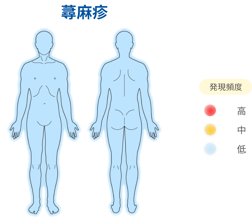 蕁麻疹