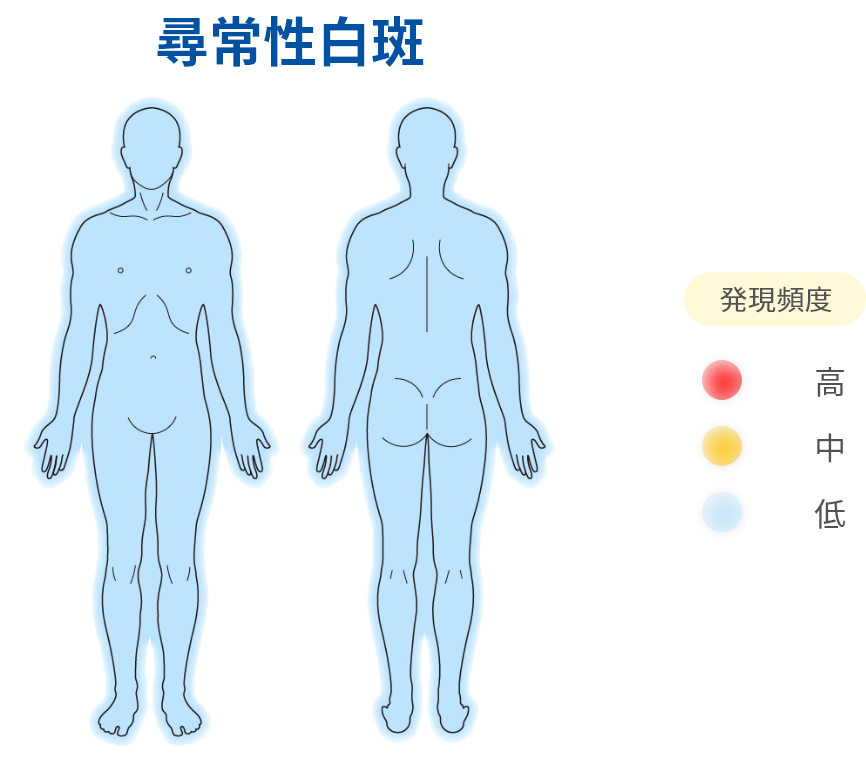 尋常性白斑