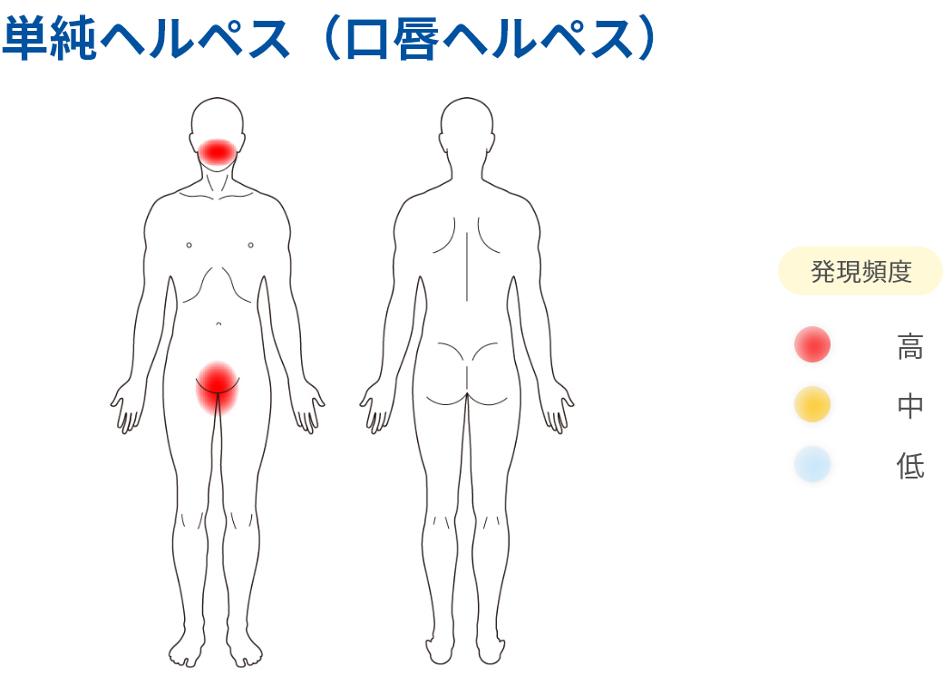単純ヘルペス（口唇ヘルペス）