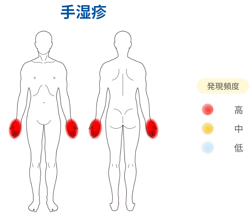 手湿疹
